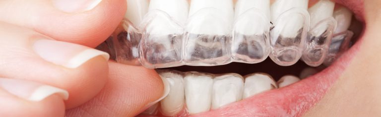 Invisalign®: Get a Beautifully Straight Smile