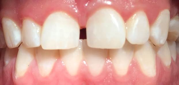 Loss of tooth characteristics