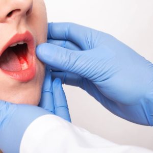 Oral Cancer Screening