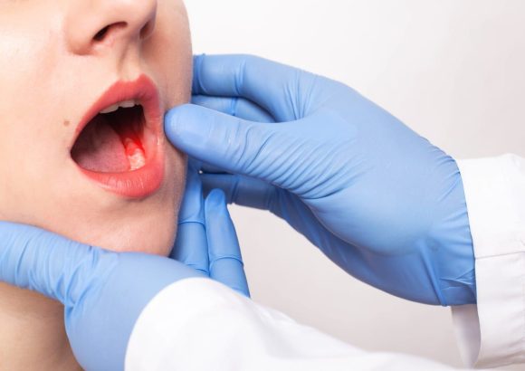 Oral Cancer Screening